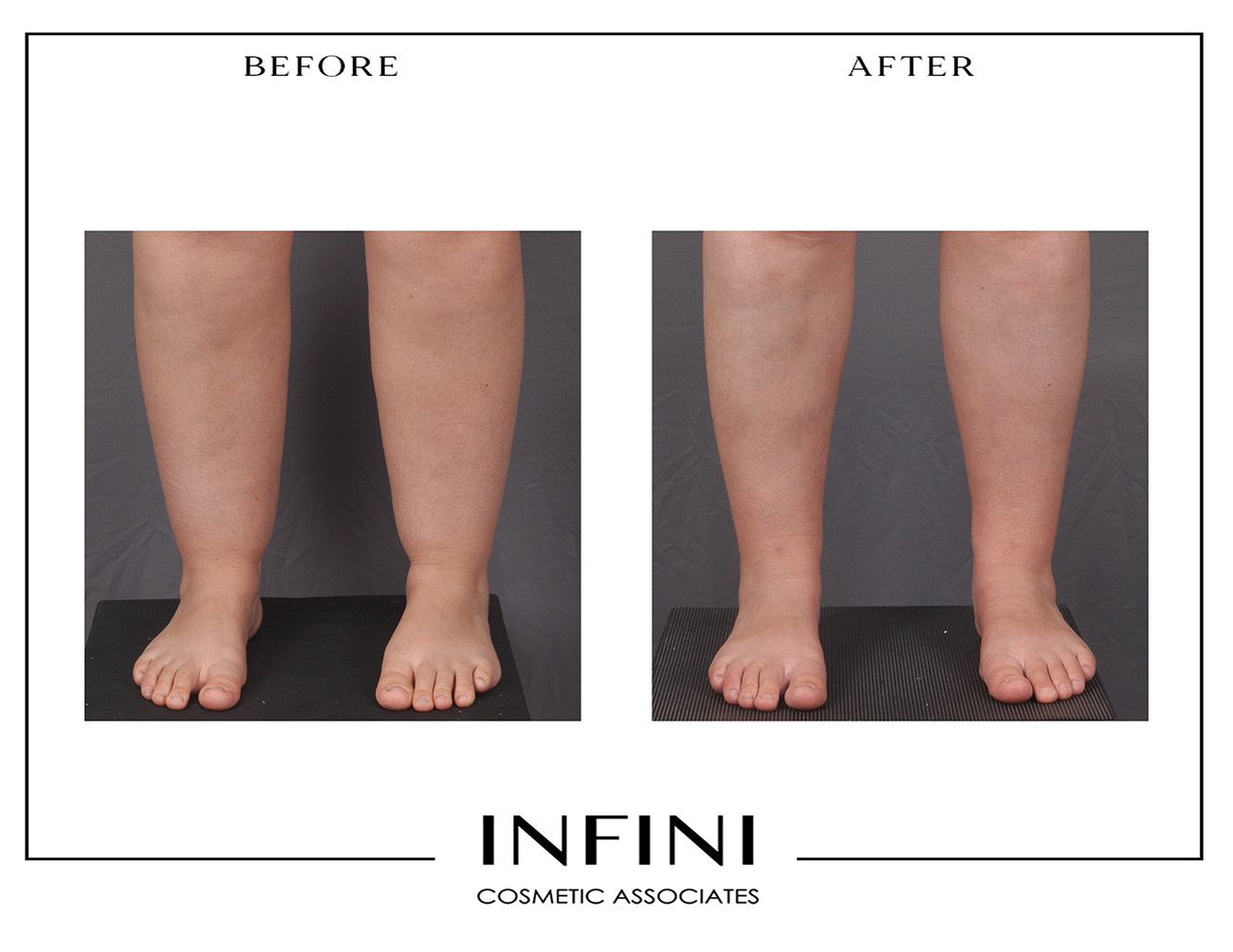 Lipedema before and after photo 1
