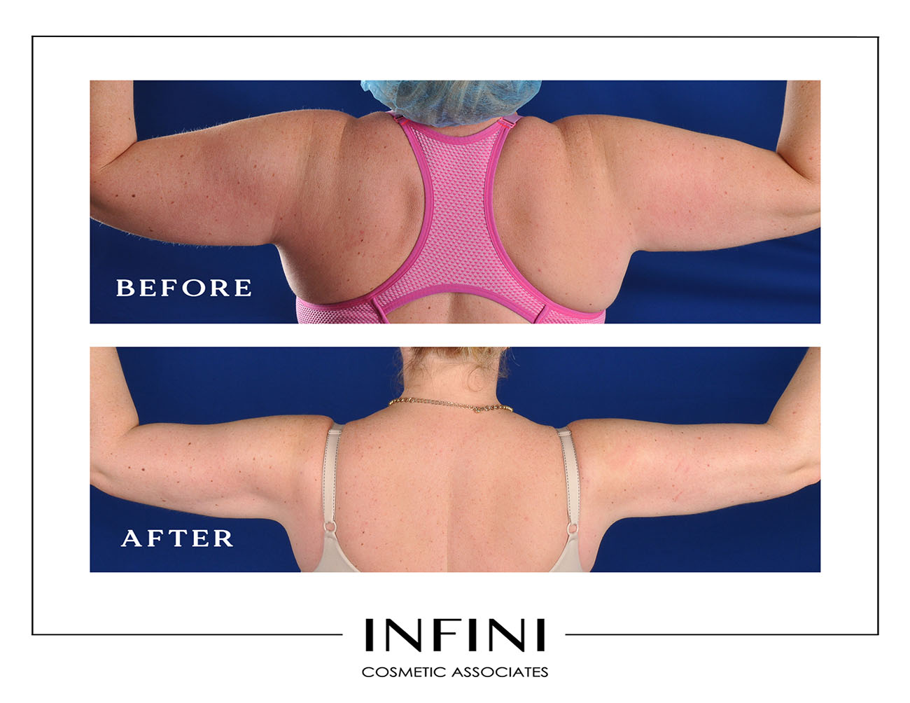Lipedema before and after photo 2