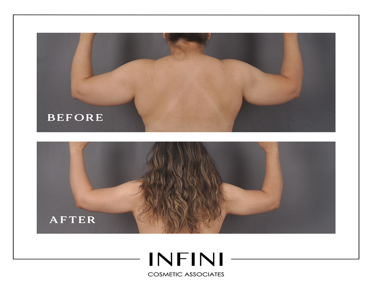 Lipedema before and after photo 3