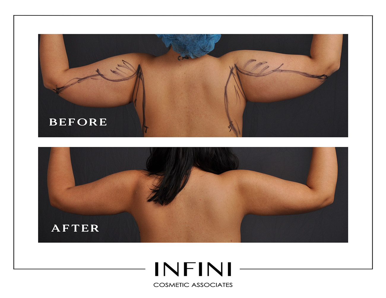 Lipedema before and after photo 4