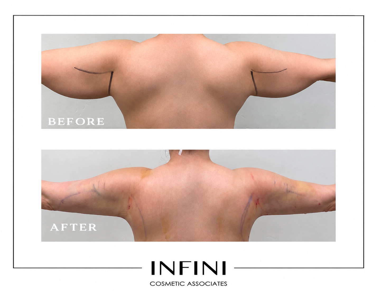 Lipedema before and after photo 5