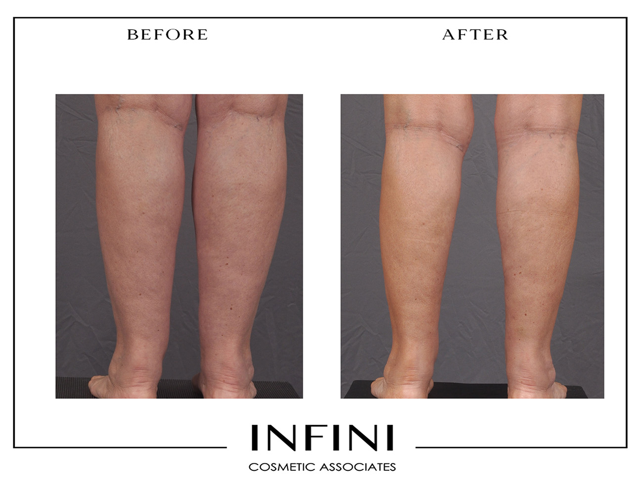 Lipedema before and after photo 6