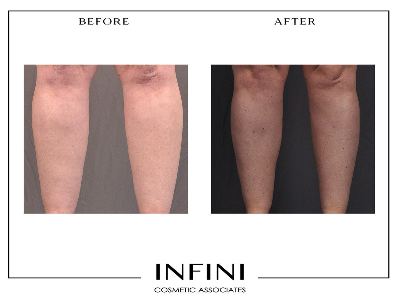 Lipedema before and after photo 7