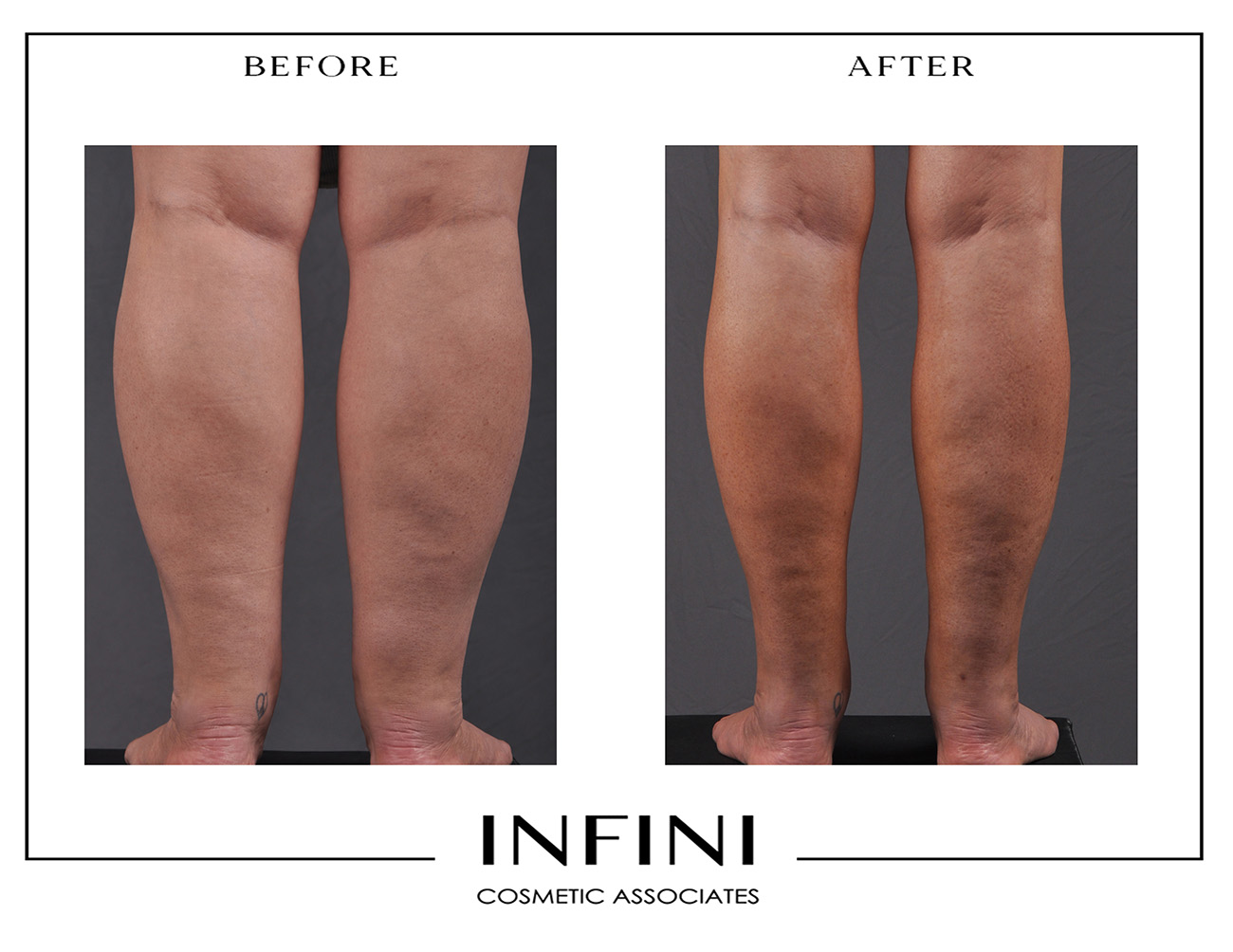 Lipedema before and after photo 8