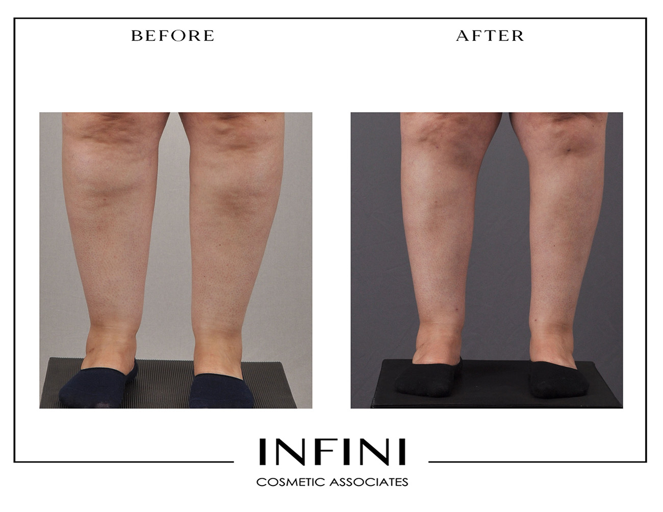Lipedema before and after photo 9