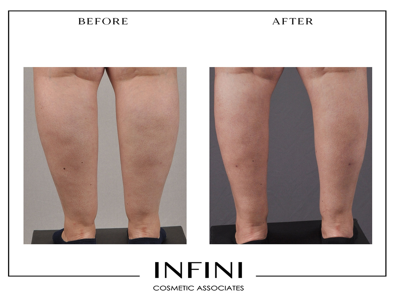 Lipedema before and after photo 10