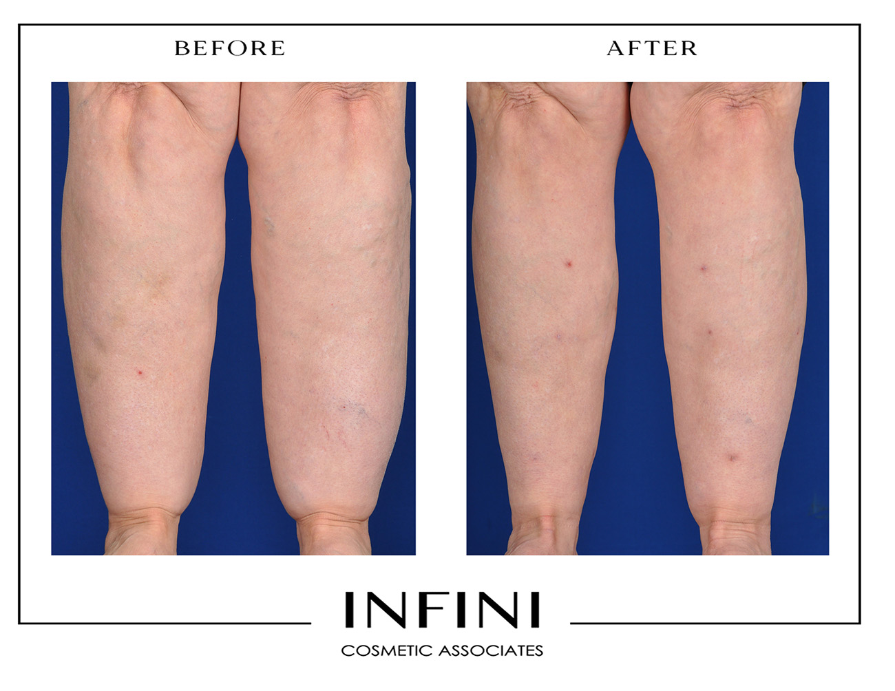 Lipedema before and after photo 11