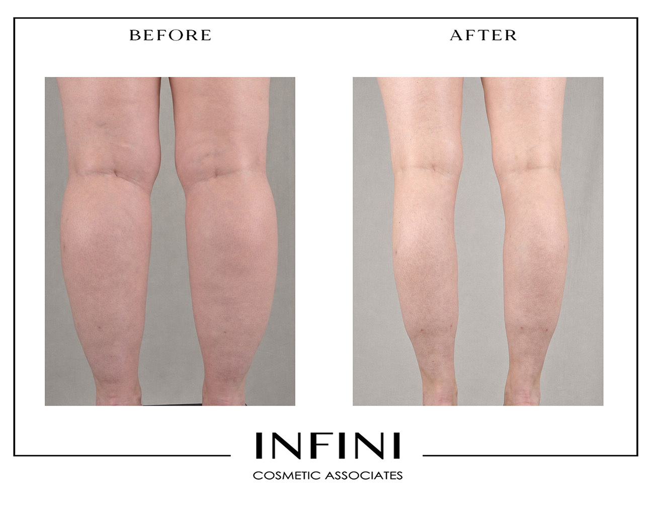Lipedema before and after photo 12