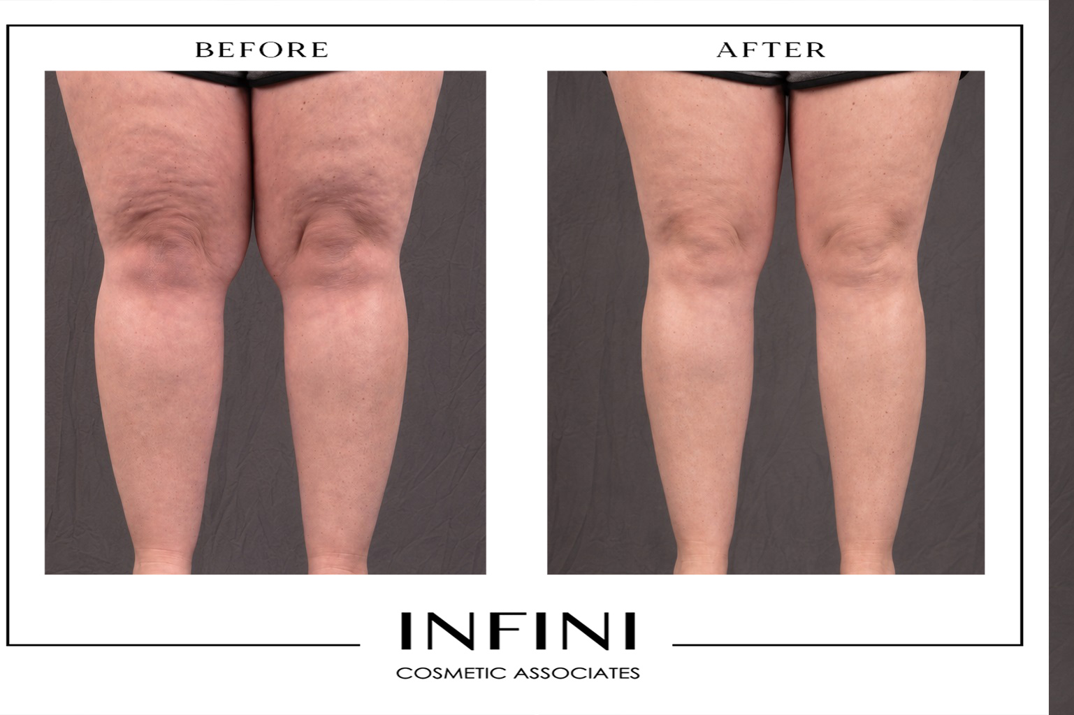 Lipedema before and after photo 13