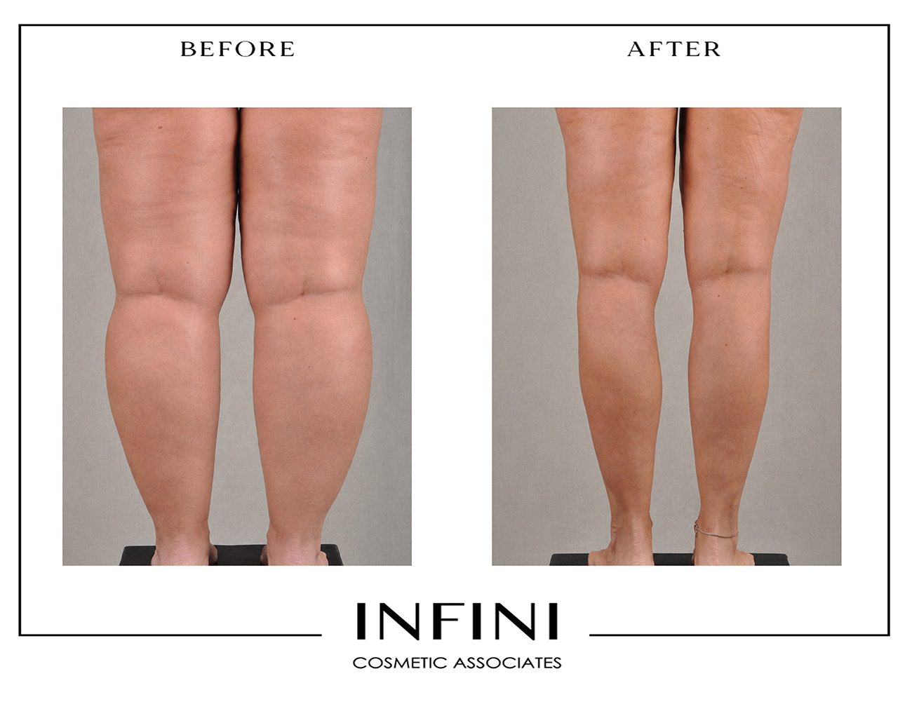 Lipedema before and after photo 14