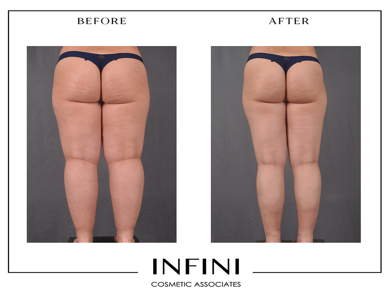 Lipedema before and after photo 15