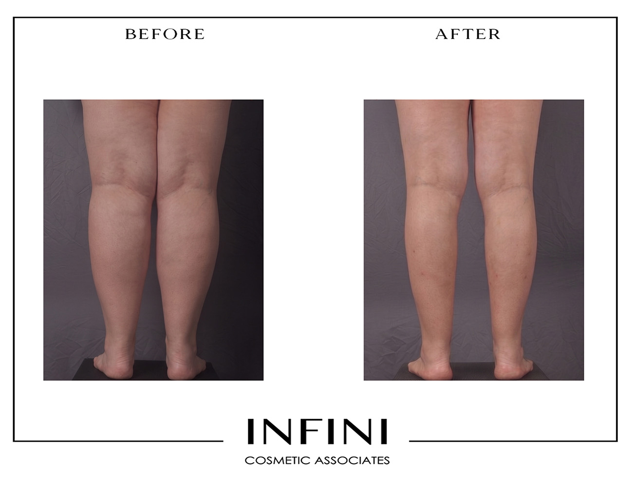 Lipedema before and after photo 16
