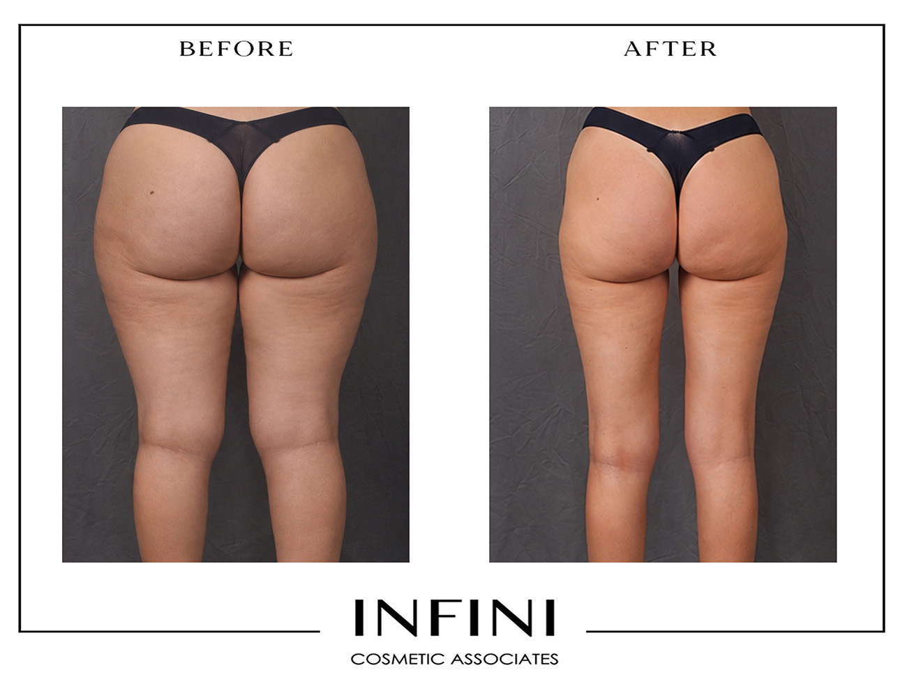 Lipedema before and after photo 17