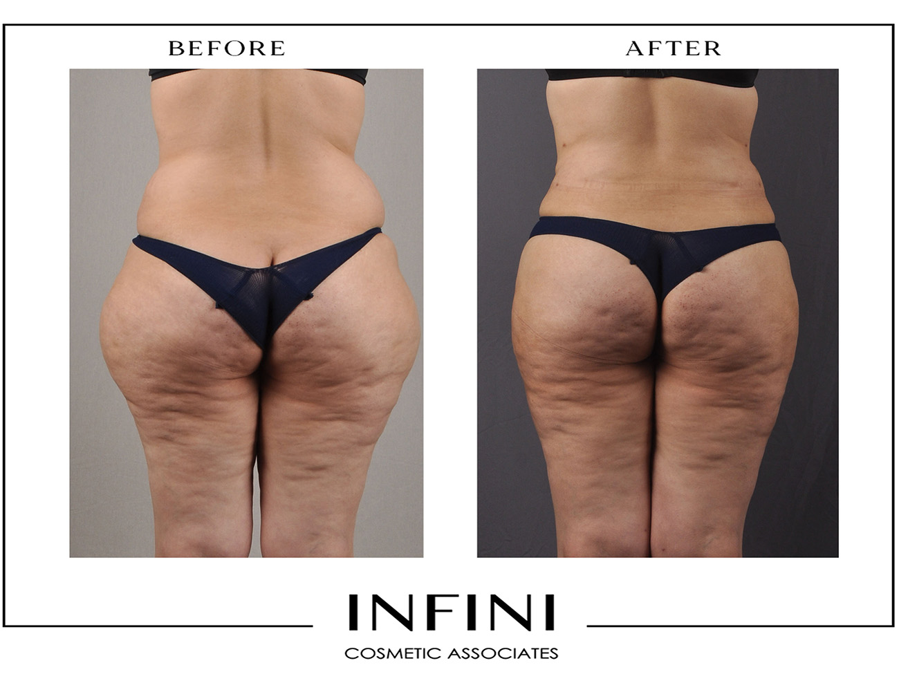 Lipedema before and after photo 18