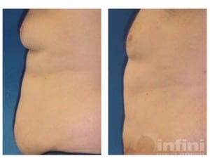 Male Liposuction 2ChestFose