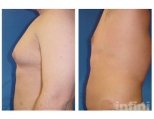 Male Liposuction