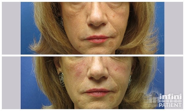 Voluma cheek volume result &mdash; patient 1