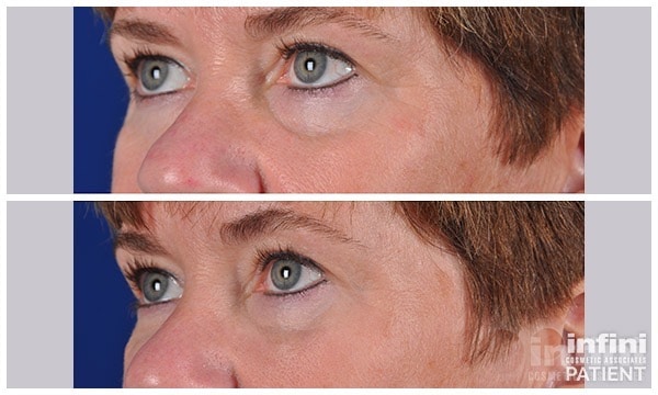 Voluma cheek volume result &mdash; patient 2