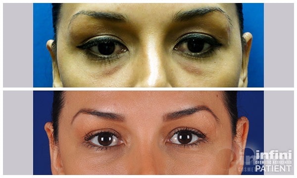 Voluma cheek volume result &mdash; patient 3