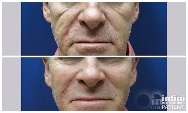 Voluma cheek volume result &mdash; patient 4