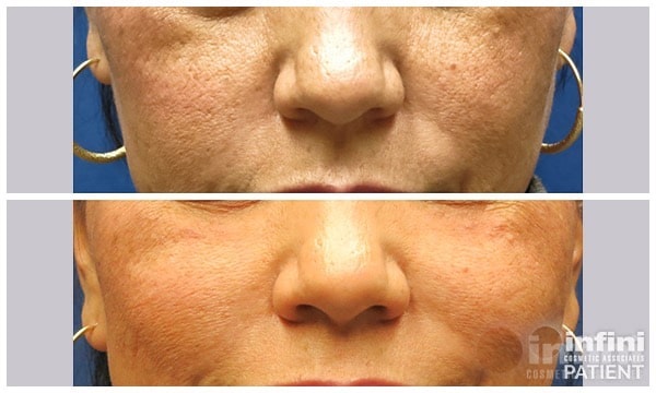 Voluma cheek volume result &mdash; patient 5