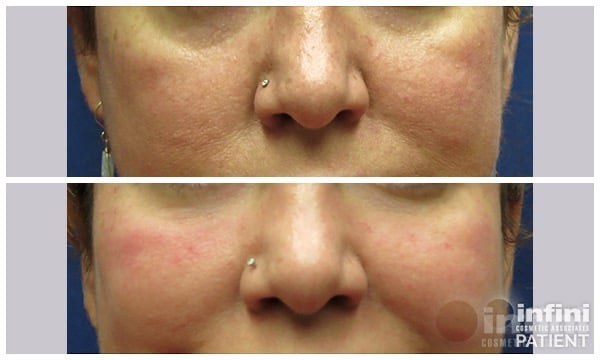 Voluma cheek volume result &mdash; patient 6