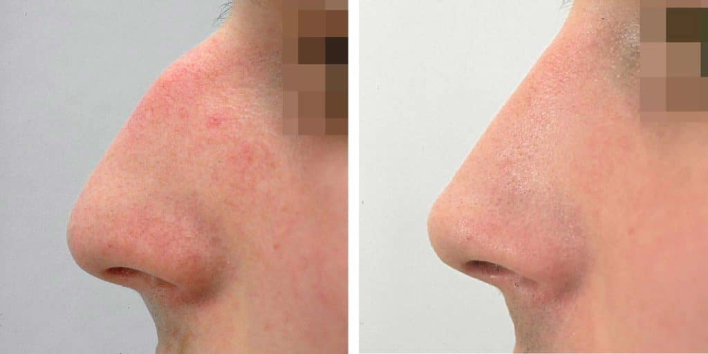 Non-Surgical Nose Job
