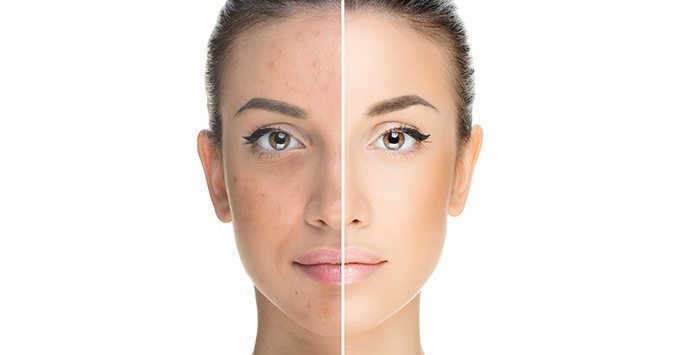 Acne Treatment