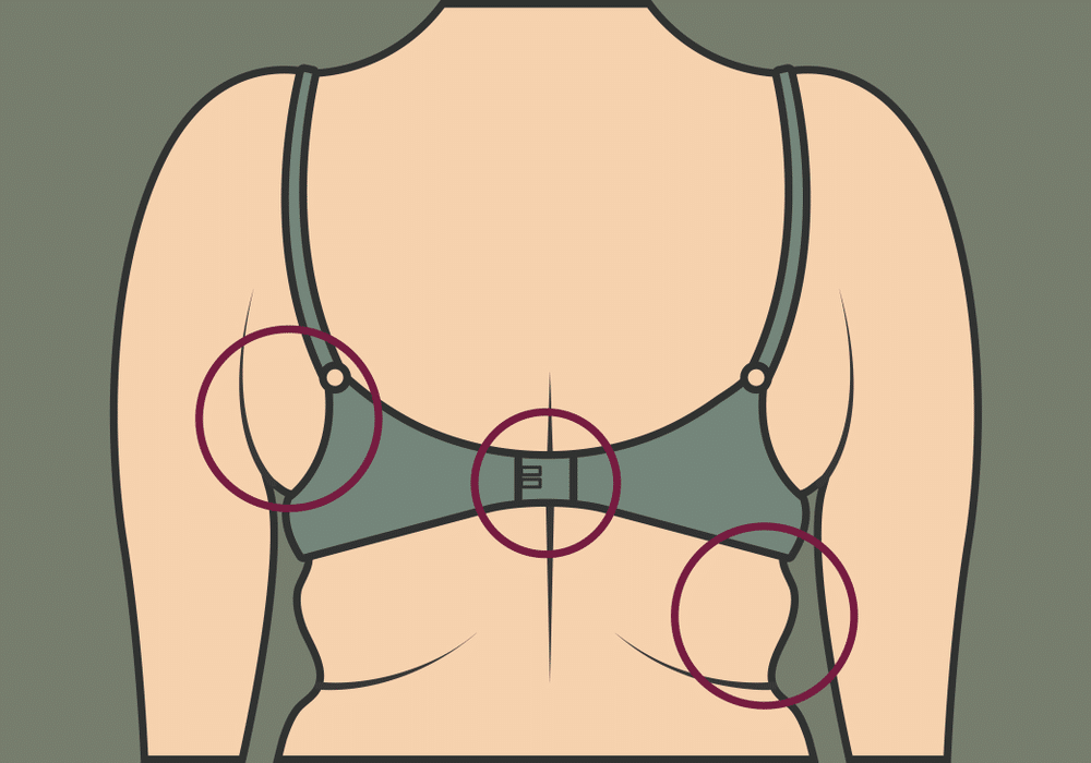 Back and Bra Liposuction