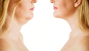 Neck and Chin Liposuction