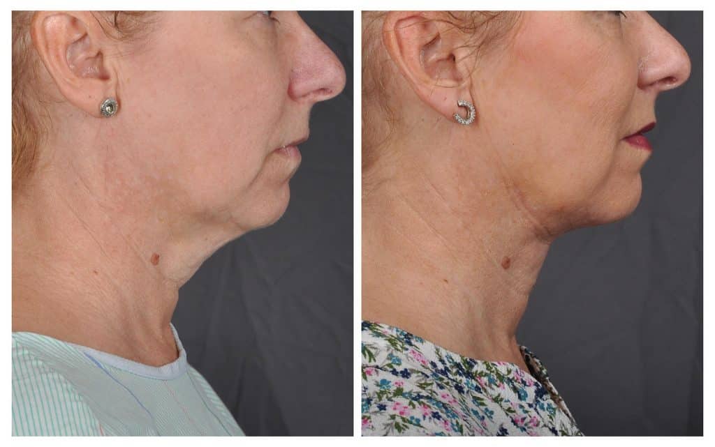 J-plasma neck tightening before and after - Patient 1