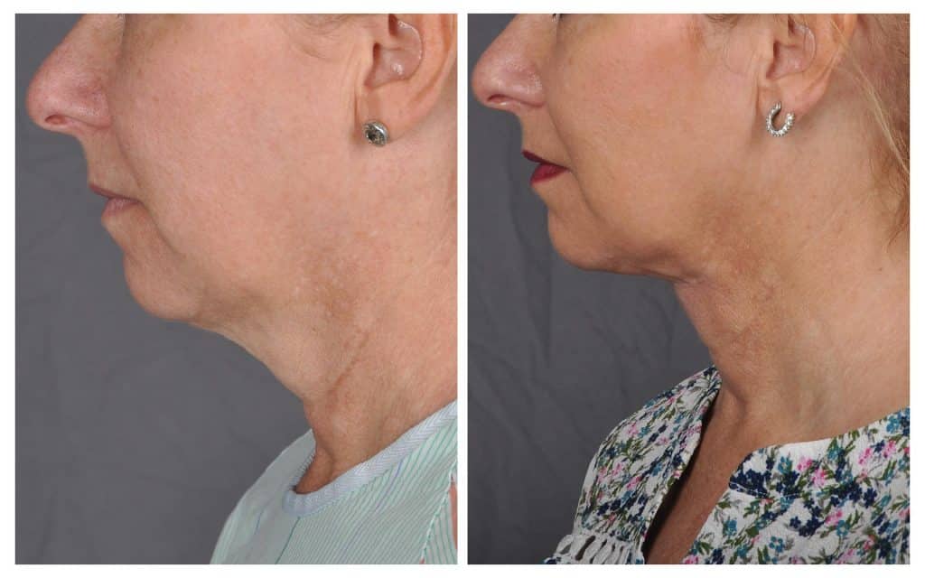 J-plasma skin tightening before and after - Patient 2