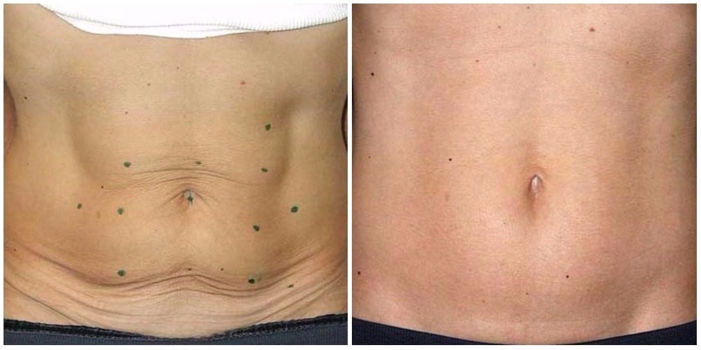 Thermage Skin Tightening