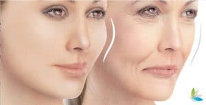 Voluma for Facial Volume