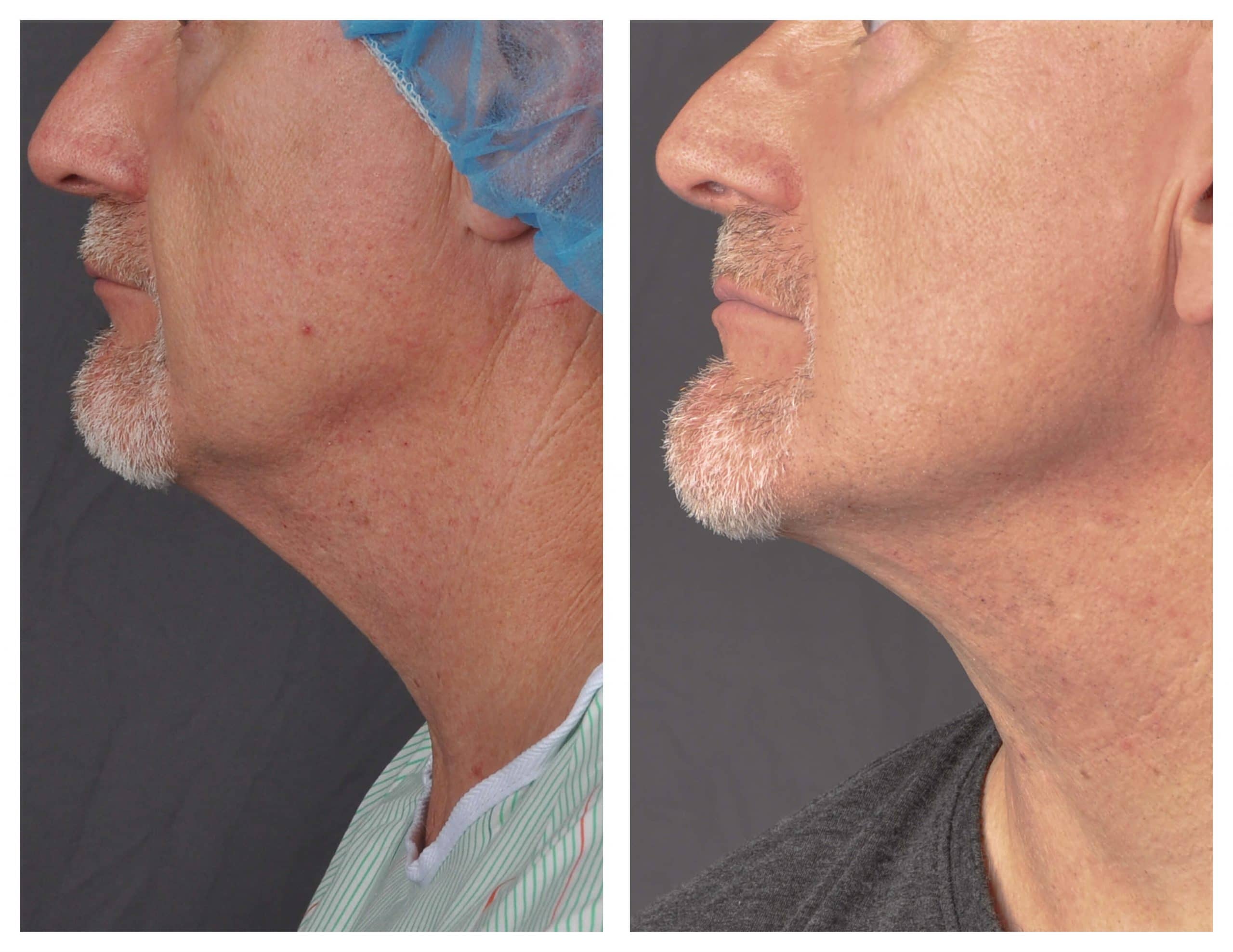 Renuvion skin tightening results - Patient 4