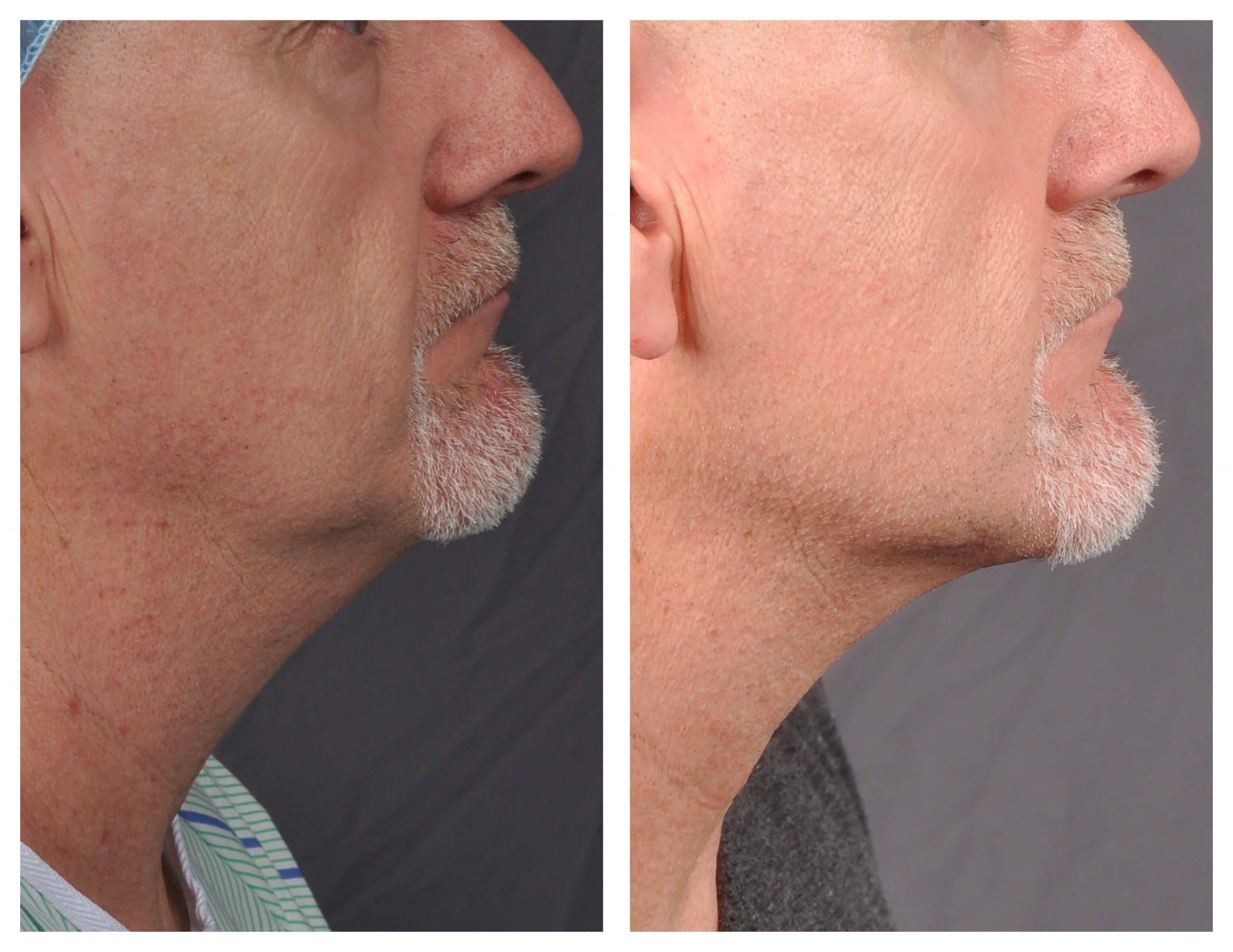 J-plasma chin tightening - Patient 3