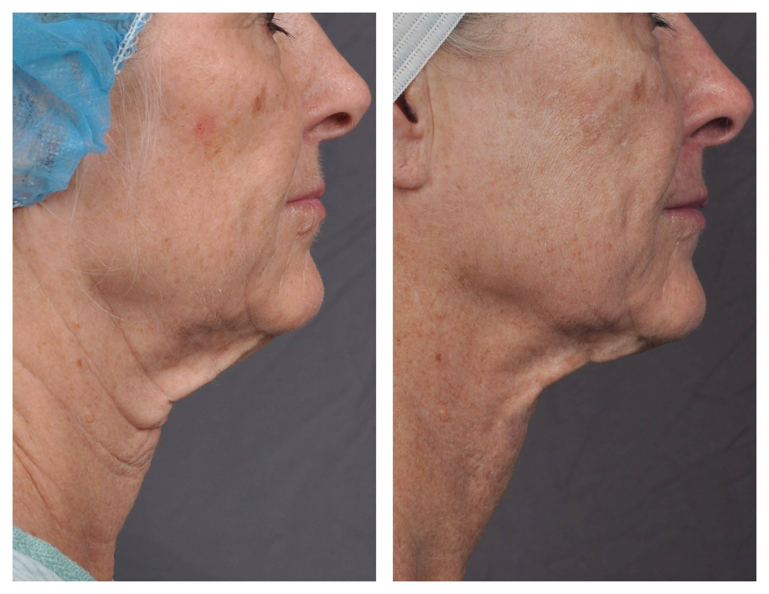 Neck J-Plasma treatment - Patient 5