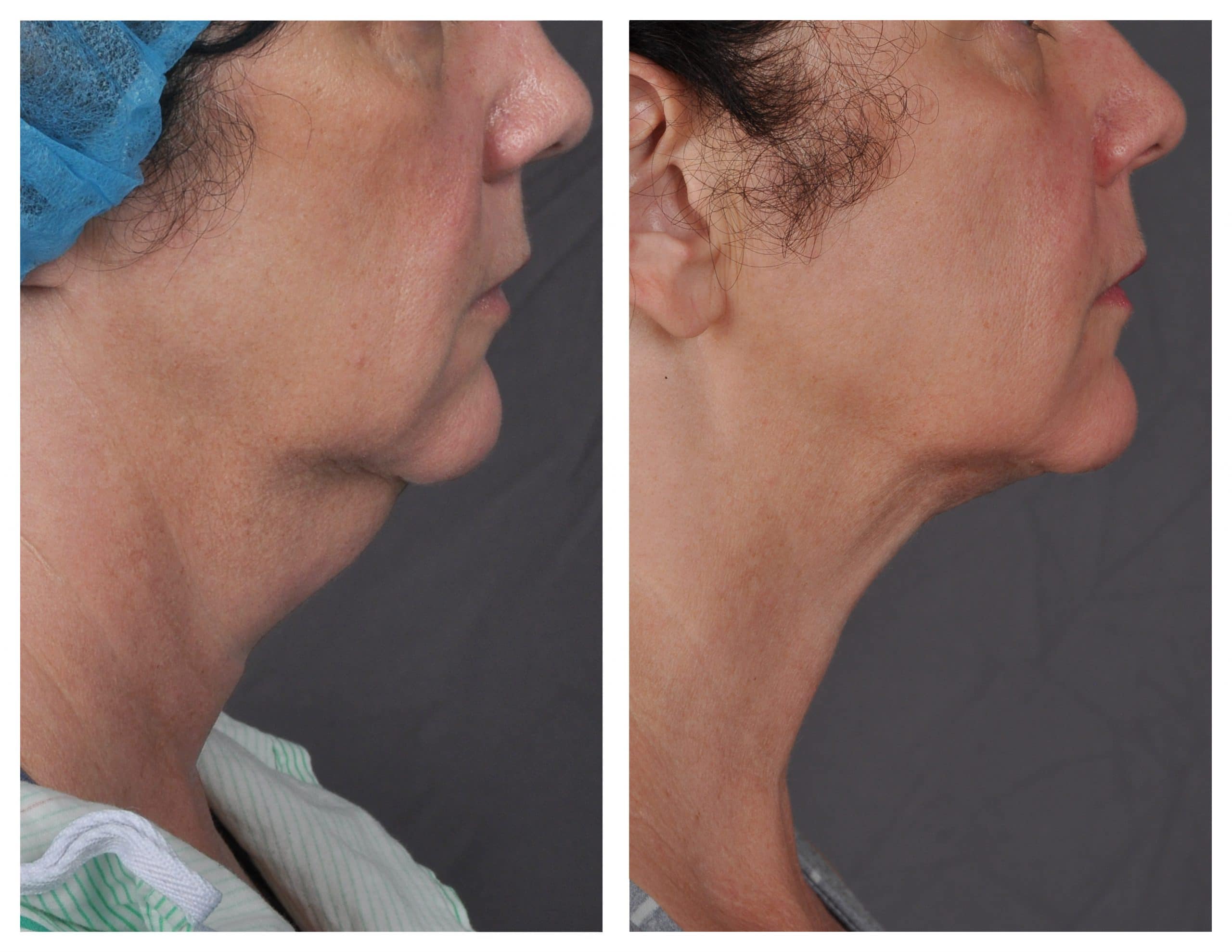 Neck tightening results - Patient 6