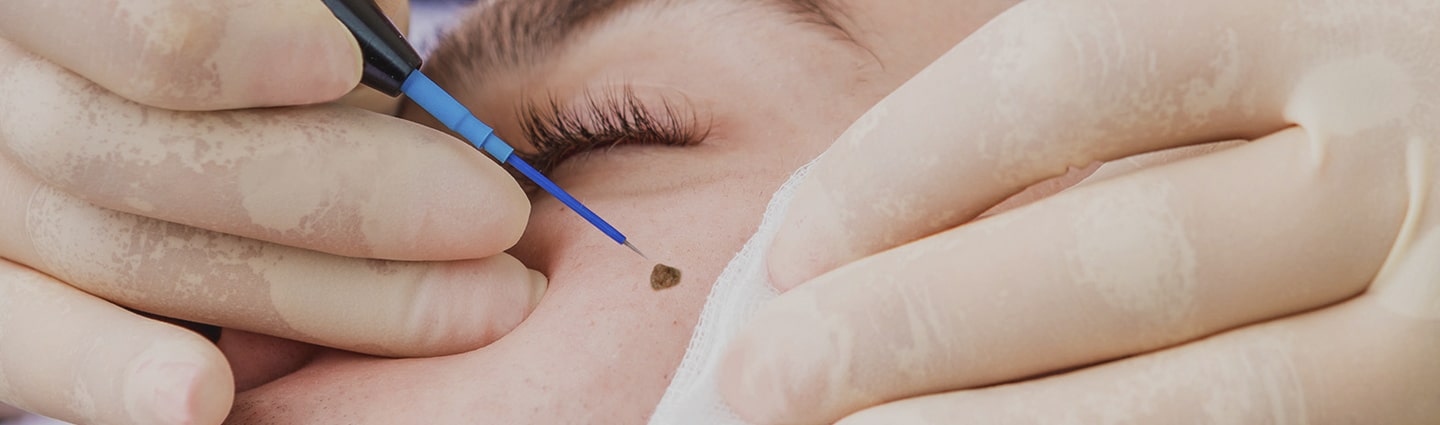 Cosmetic mole removal consultation in Scottsdale