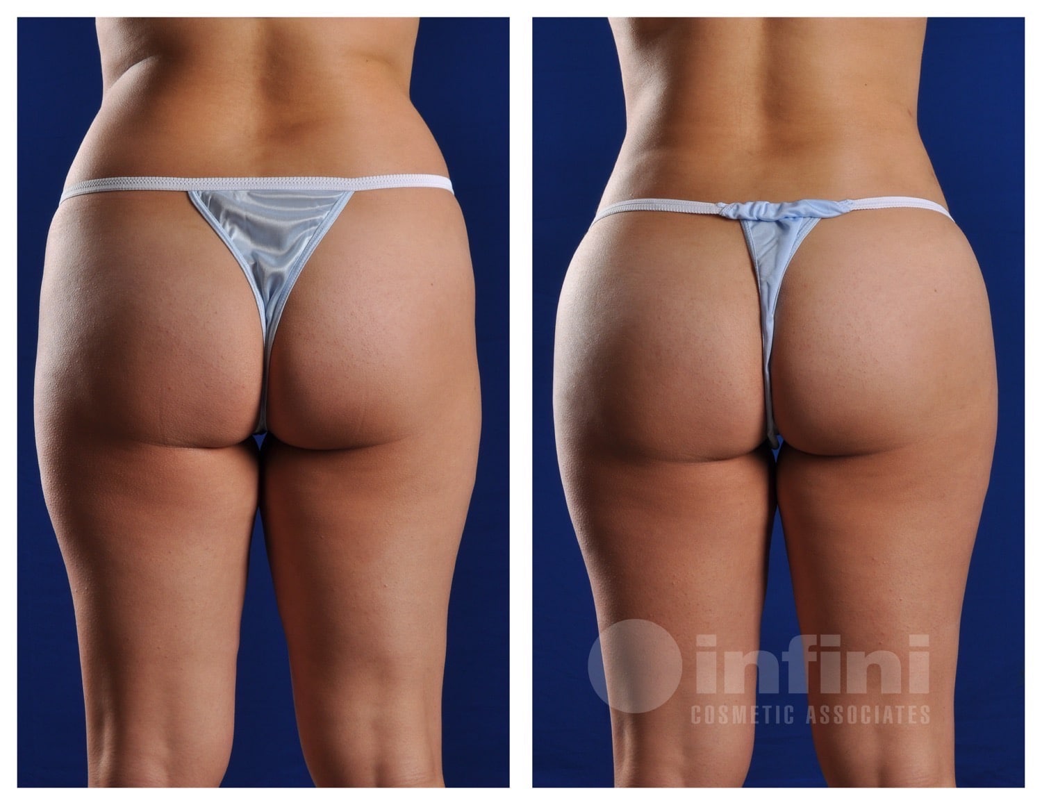 BBL before and after results Scottsdale Patient 2