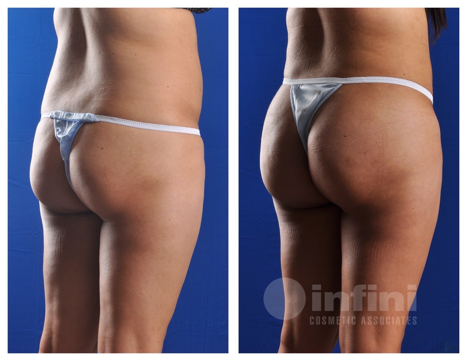 BBL before and after results Scottsdale Patient 3
