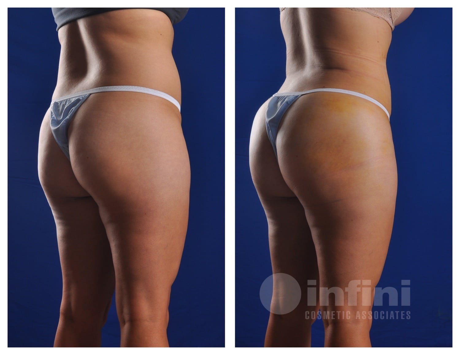 BBL before and after results Scottsdale Patient 1