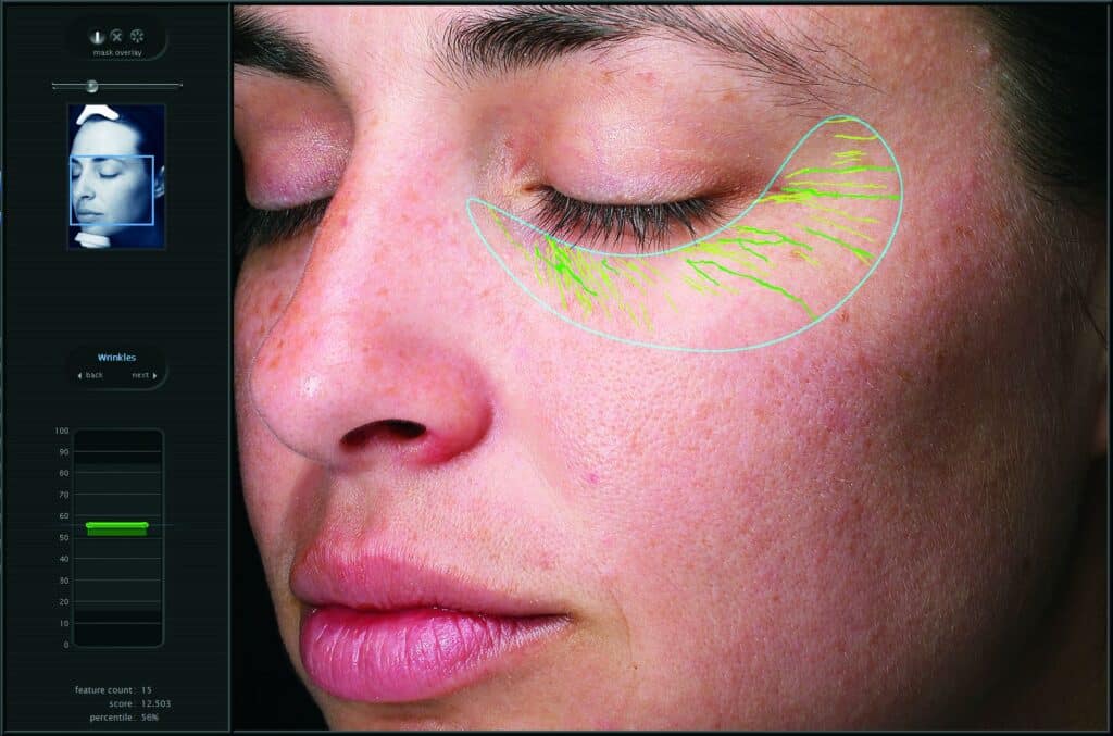 VISIA Skin Analysis detecting wrinkles and sun damage