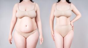 Why Hypothyroidism Is Often Misdiagnosed and How It Changes Your Body Shape