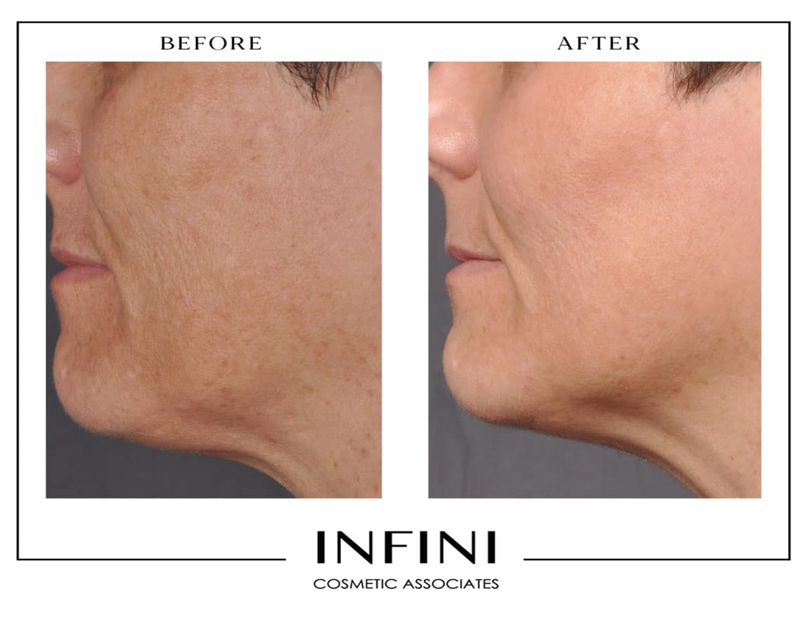 Laser Peel before and after results - Patient 2