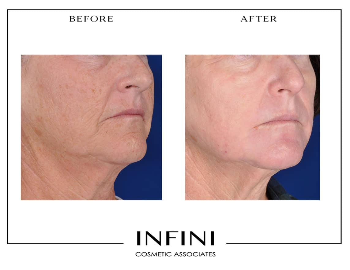Laser Peel before and after results - Patient 5