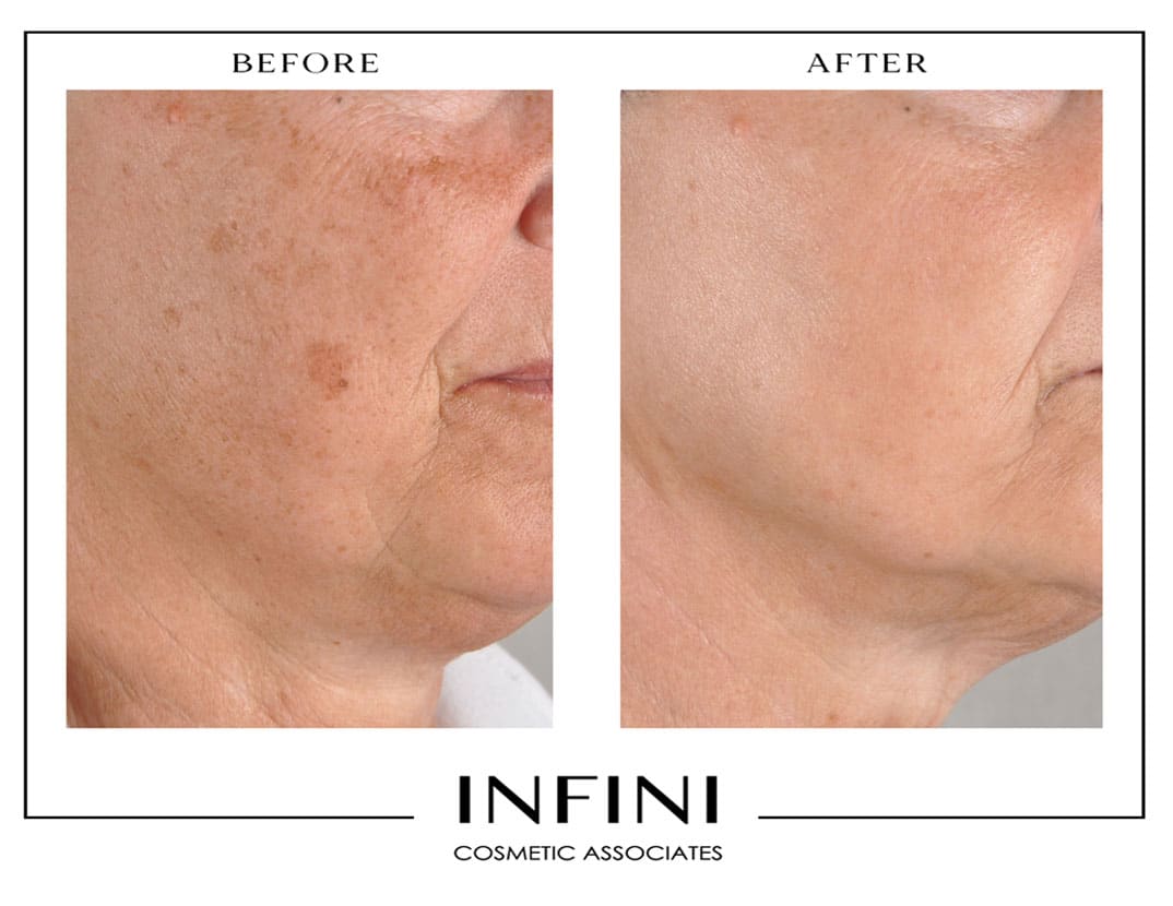 Photofacial before and after results - Patient 2