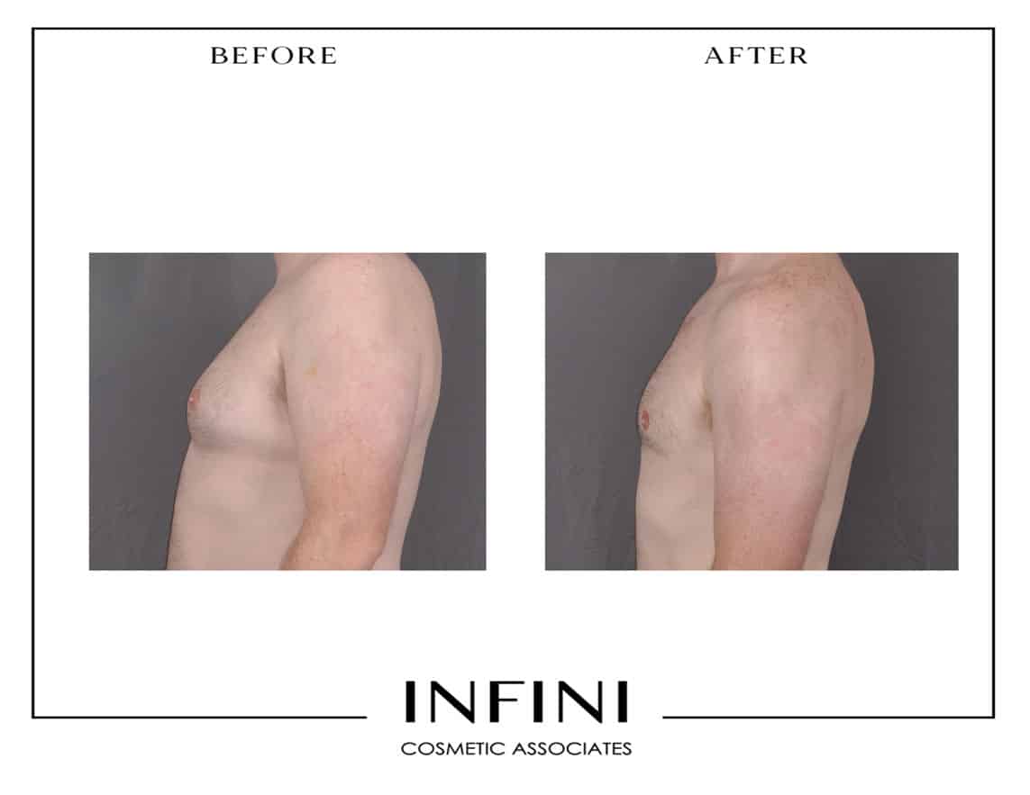 Gynecomastia before and after results - Patient 3