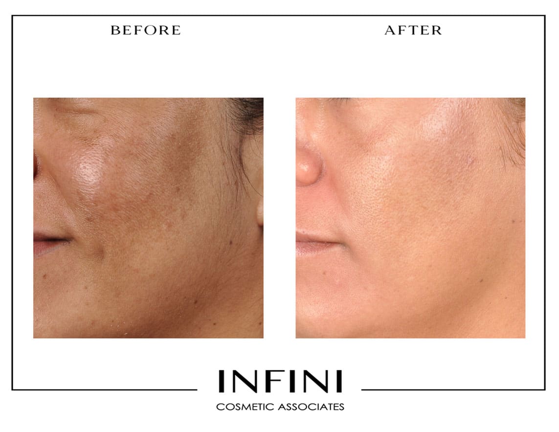 Chemical Peel before and after results - Patient 1