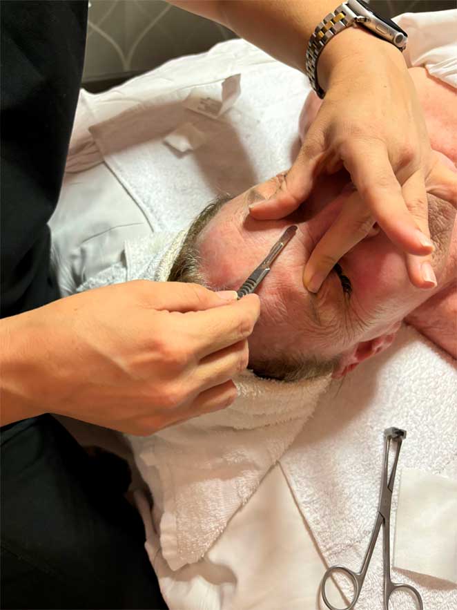 Dermaplaning treatment session